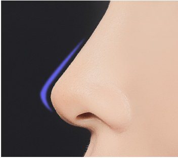 코 수술 단계 4 절개 부위 봉합 일러스트