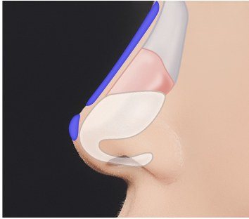 코 수술 단계 3 보형물 삽입 일러스트
