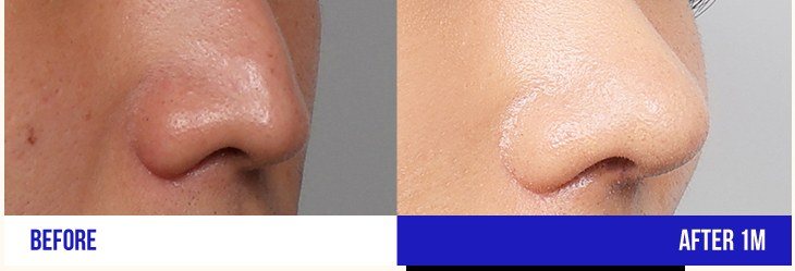 코 성형 전후 비교 사진 1