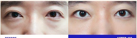 눈 성형 전후 사진
