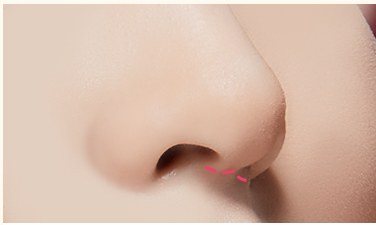 절개방법 선택 과정 일러스트