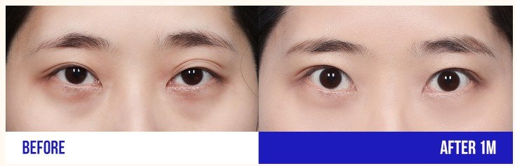 눈성형 전후 사진 (BEFORE, AFTER 1M)