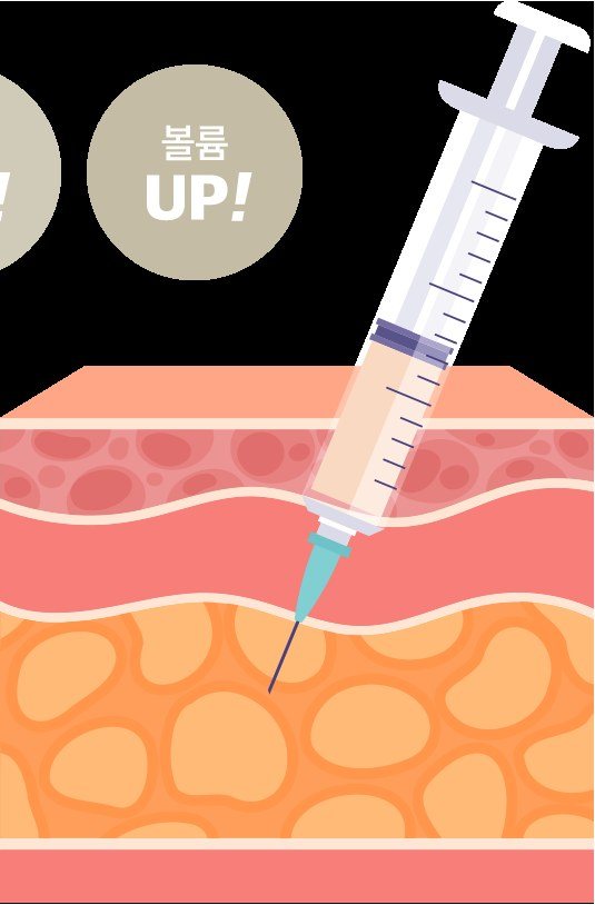 피부 단면 층에 주사기로 지방을 주입하는 일러스트