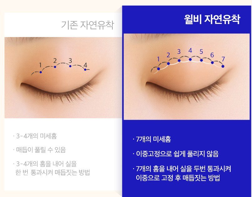 기존 자연유착과 윌비 자연유착 비교 도표