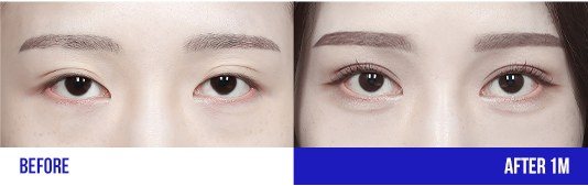 눈 성형 전후 사진 (BEFORE / AFTER 1M)