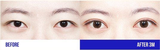 눈 성형 전후 비교 사진