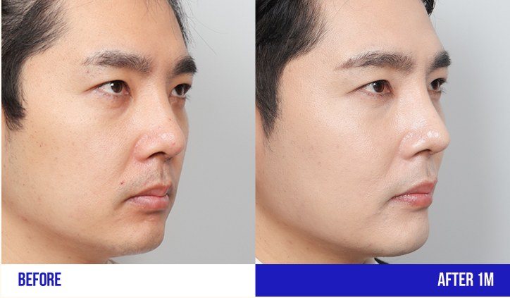 남성 코 성형 전후 사진