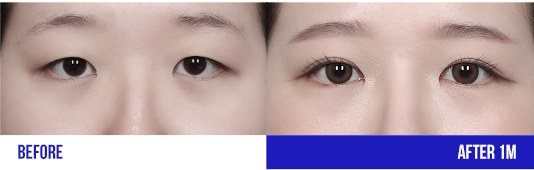 눈 성형 전후 비교 사진