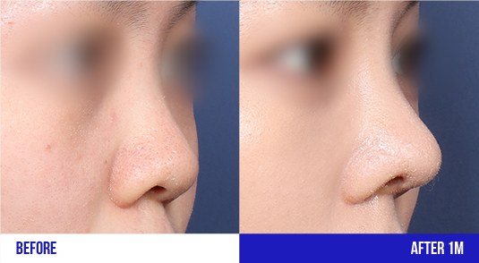 코 성형 전후 45도 측면 비교 사진