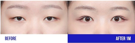 눈 성형 전후 비교 사진 (BEFORE, AFTER 1M)